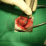 Thyroid-Gland-Surgery